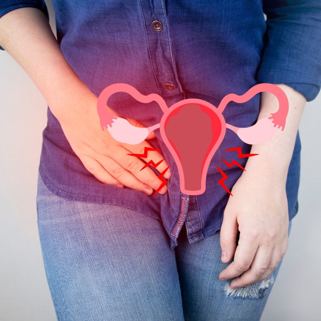Understanding Pelvic Inflammation - Expert insights from Dr. Shabnam Sharjil at PCOS Ferticure Clinic, providing valuable information and strategies for managing pelvic inflammation within the context of PCOS-PCOD.