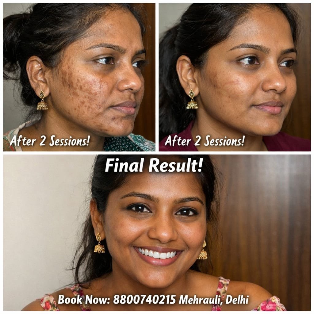 Collagen stimulation acne scars