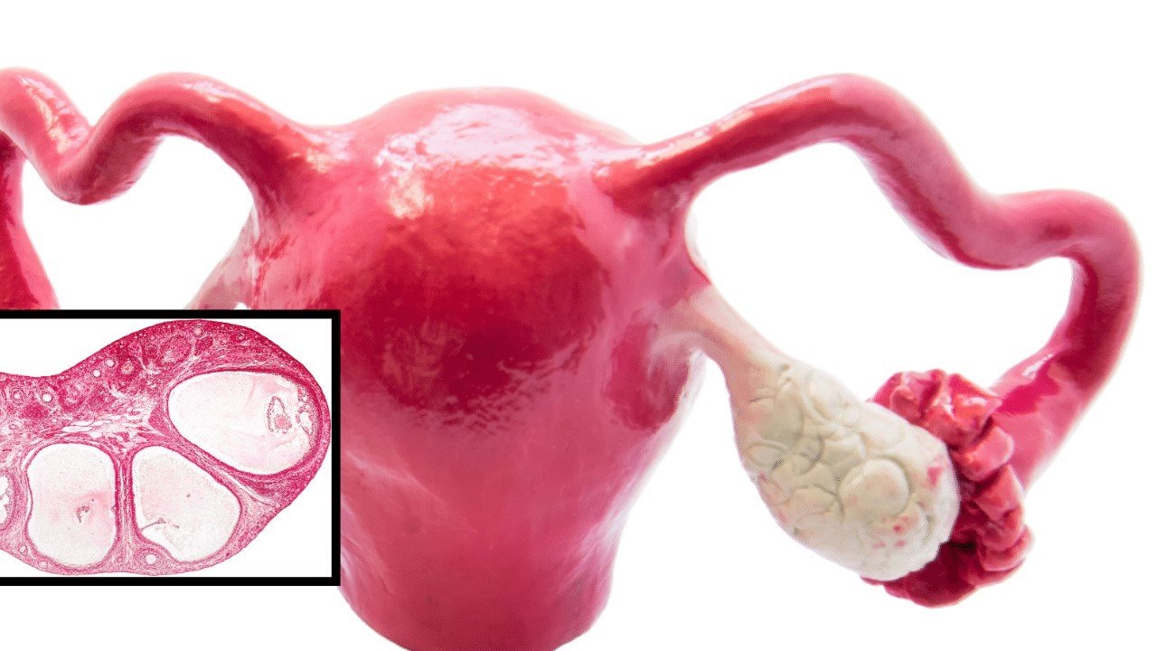 Expert PCOS Treatment by Dr. Shabnam Sharjil - Discover personalized care for PCOS from a renowned specialist at PCOS Ferticure Clinic. Trusted solutions for managing PCOS and achieving reproductive wellness.