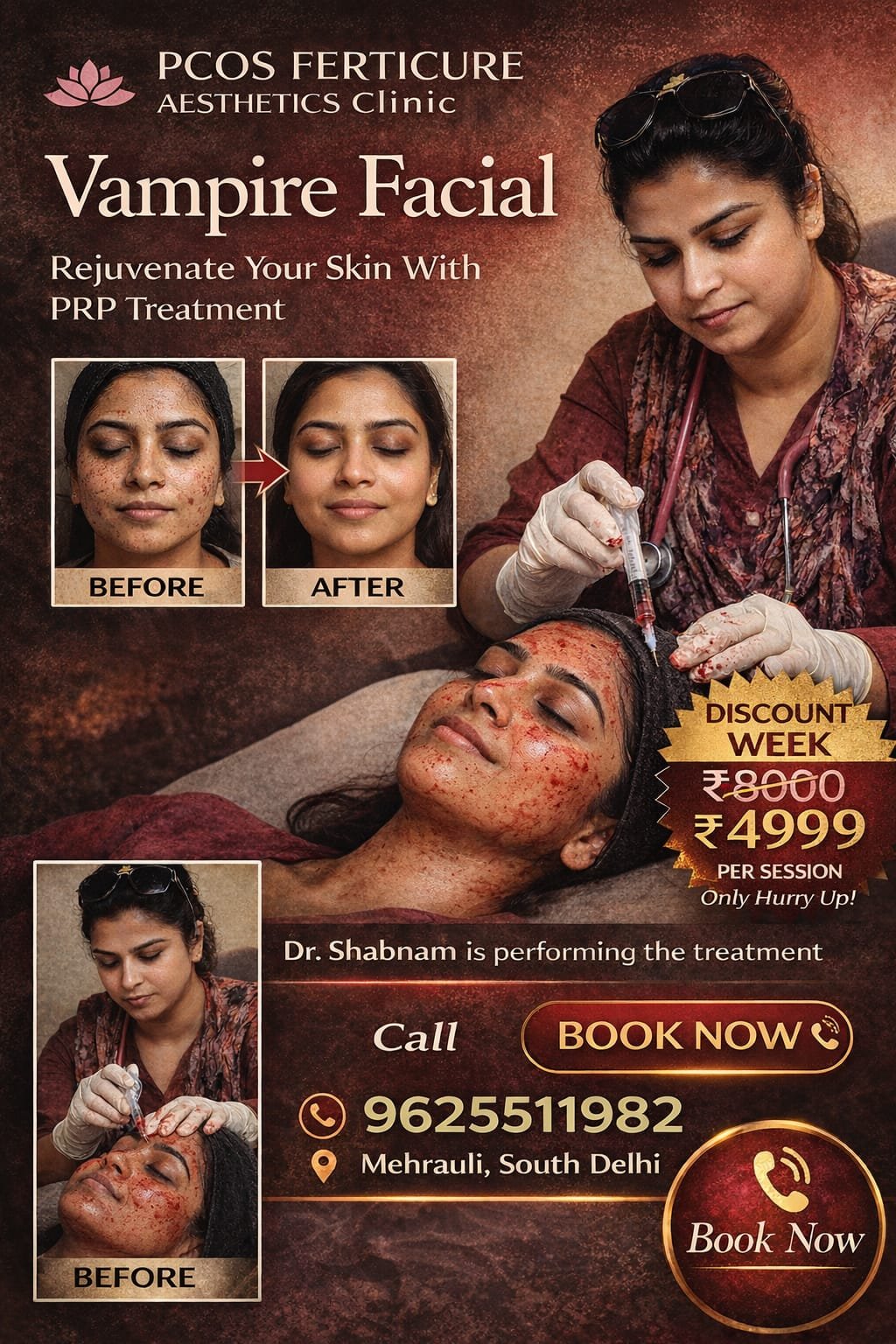Vampire facial PRP treatment Delhi