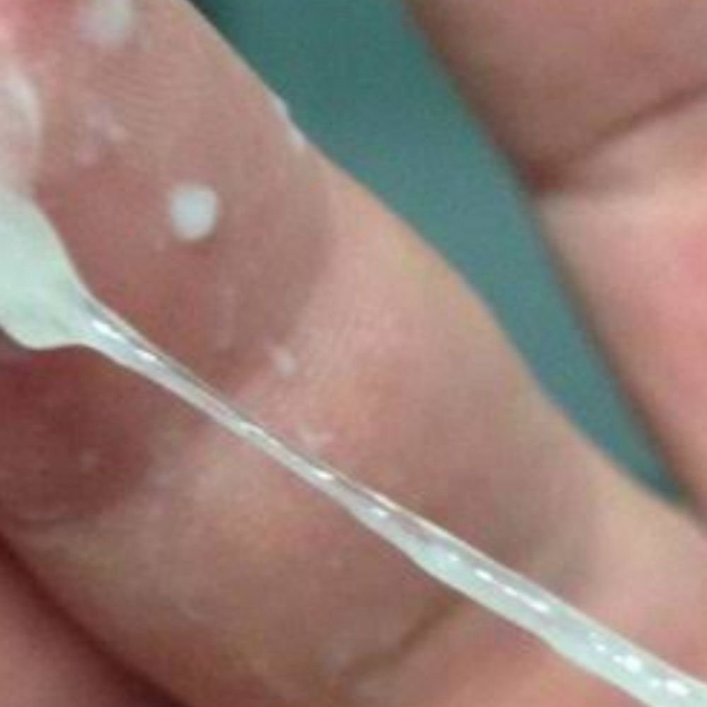 White Discharge Treatment PCOS