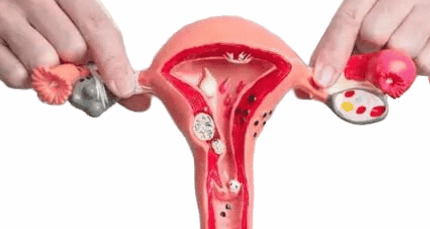 Effective PCOD Treatment - Dr. Shabnam Sharjil at PCOS Ferticure Clinic provides expert insights and guidance on successful PCOD treatment. Explore proven strategies, tips, and personalized approaches for managing PCOD within the context of PCOS-PCOD.