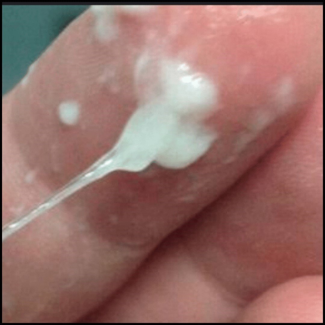 White Discharge in PID - Explore comprehensive insights on white discharge and its correlation with Pelvic Inflammatory Disease (PID) with expert guidance from Dr. Shabnam Sharjil at PCOS Ferticure Clinic in the context of PCOS-PCOD.